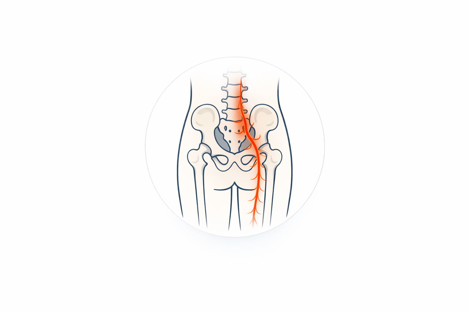Piriformis syndrome illustration