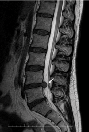 MRI of the spine showing disc herniation and nerve compression